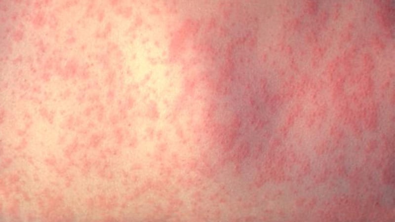 A patient with a measles rash.