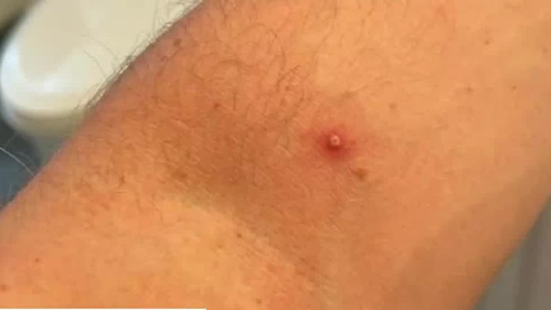 Niño con viruela del mono en Georgia.