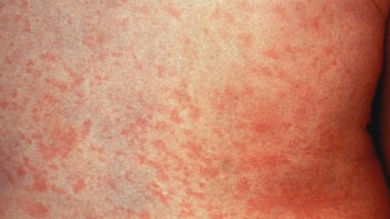 Measles