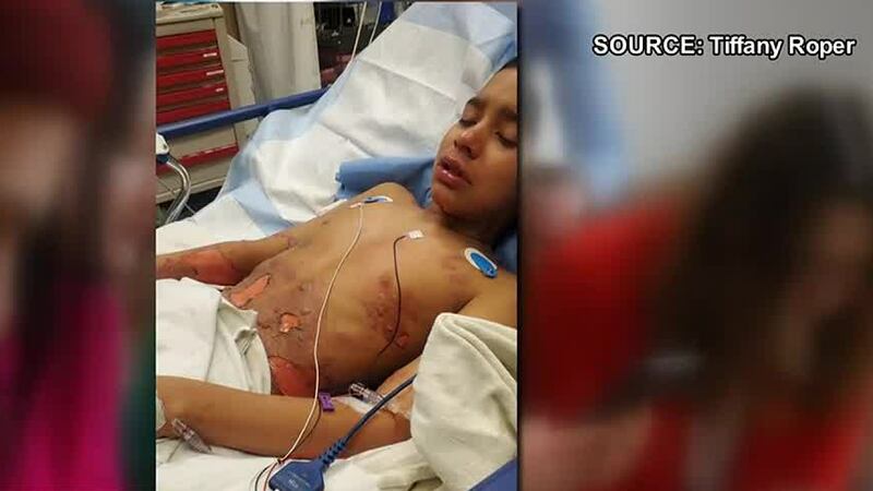 Tiffany Roper dijo que su pequeño hijo Corey sufrió quemaduras de segundo y tercer grado...