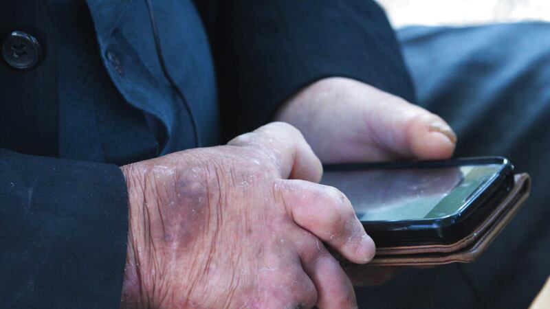 Lepra en Estados Unidos hoy